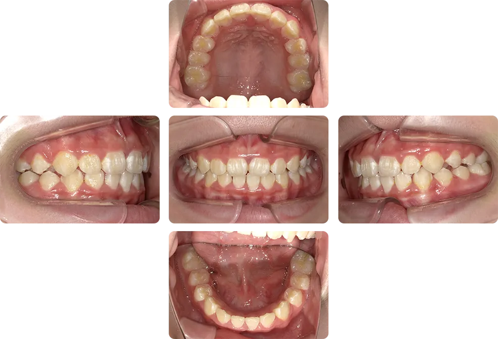 治療後 口腔内写真