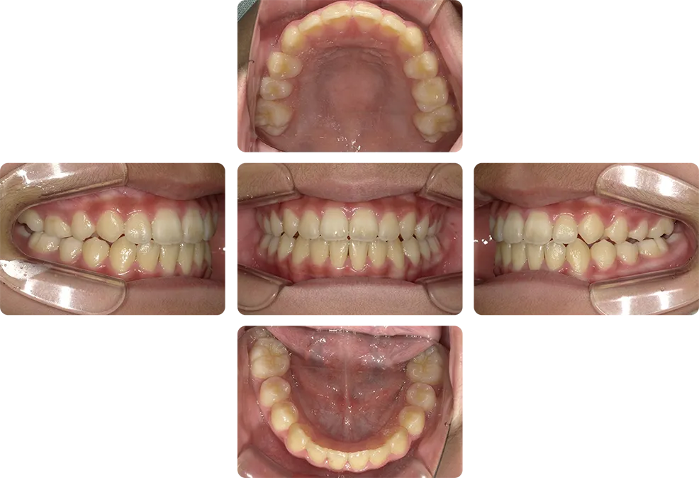 治療後 口腔内写真