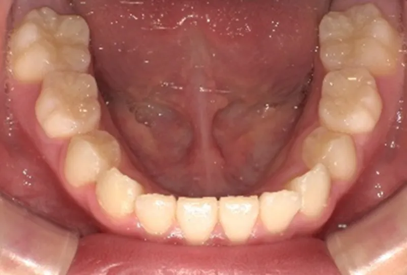 治療後 口腔内写真