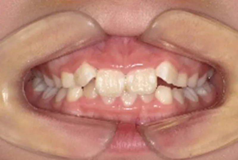 治療前 口腔内写真